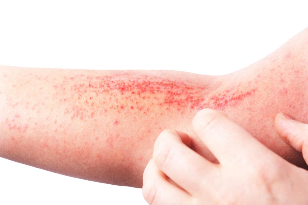 Atopic Dermatitis