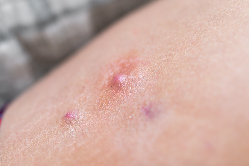 Hidradenitis Suppurativa (HS)