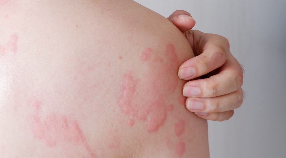 Urticaria/Hives