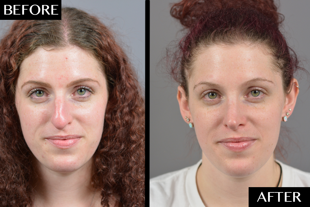 Here’s What Getting a Nose Job Is Really Like featured image