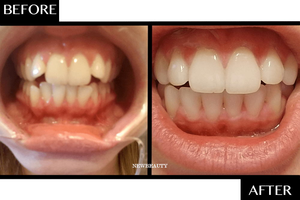 How One Woman Completely Made Over Her Smile in 4 Months—From Home featured image