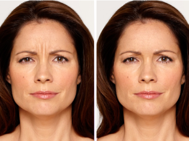 Preview How You Will Look With Botox featured image