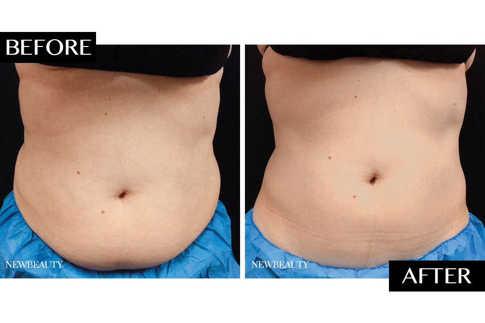 How CoolSculpting Significantly Reduced One Woman’s Midsection After Just One Treatment featured image