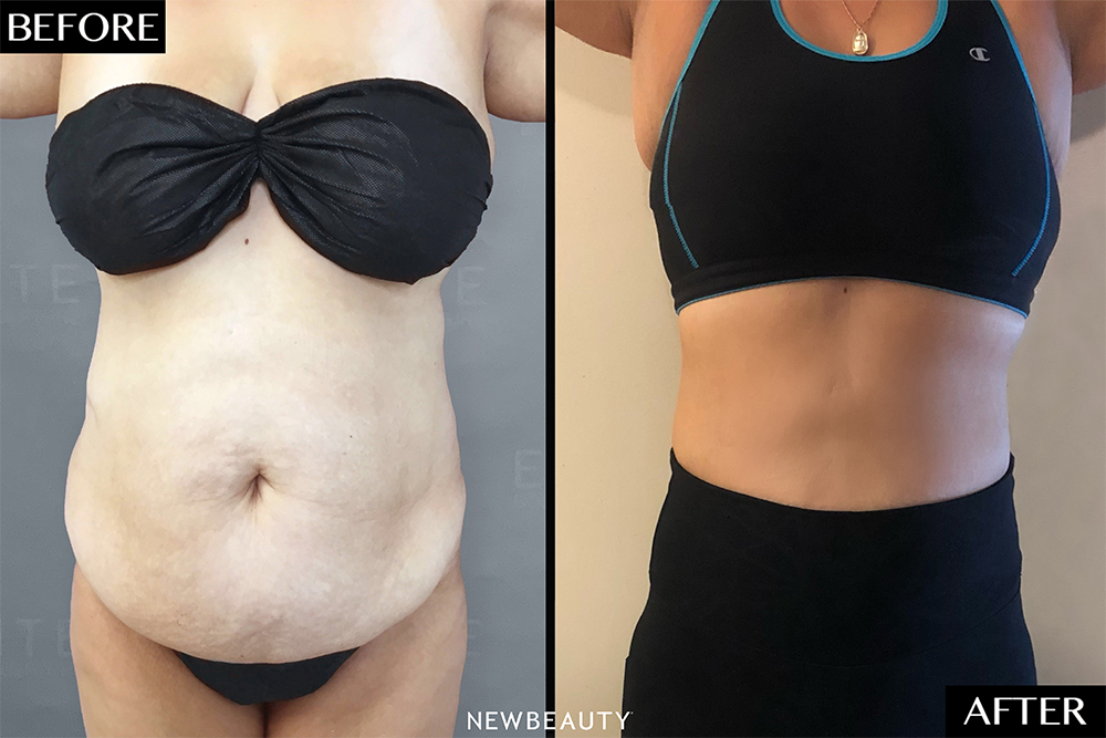 Airsculpt Before and After: How I Completely Reshaped My Body