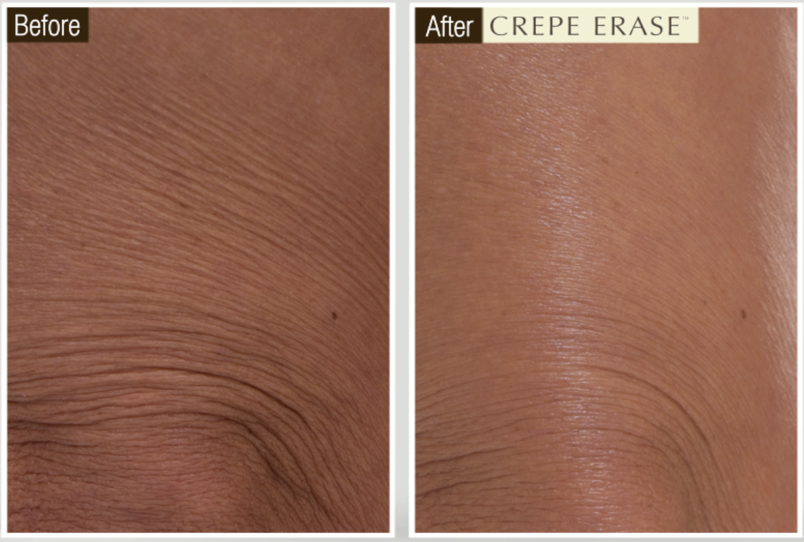 Crepe Erase - A Beautiful New Way to Skin Transformation Cream