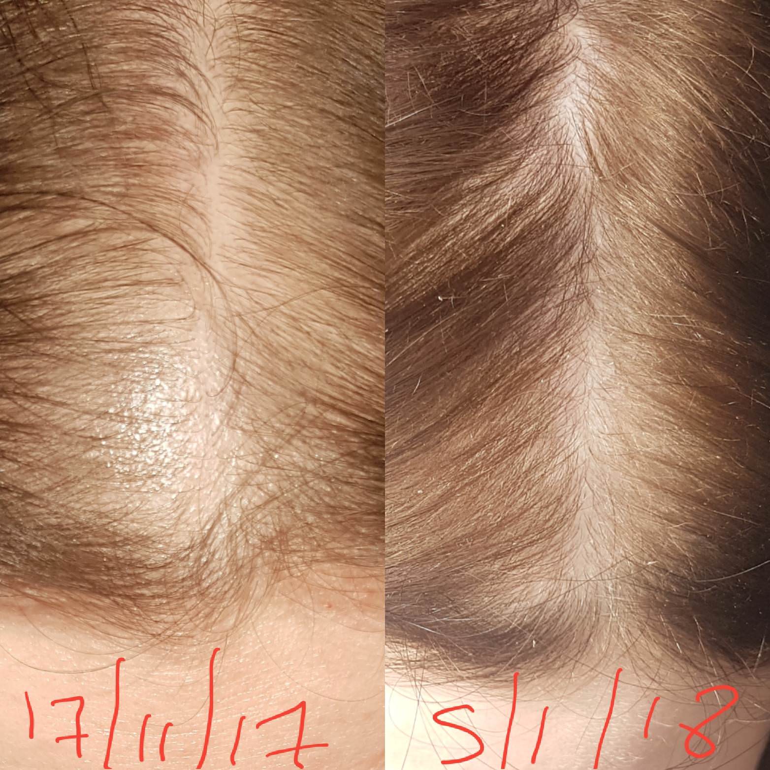 Månenytår bunke afsnit This Drugstore Product Grew One Woman's Hair Back in Just a Month and a  Half - NewBeauty