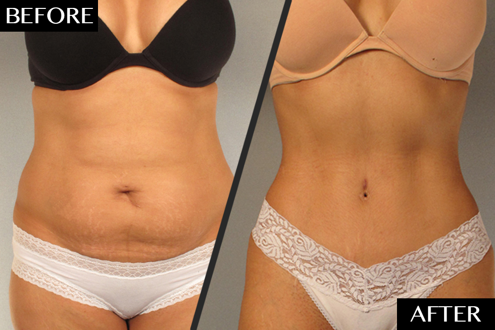 Saggy skin on the tummy: What can I do? - Hourglass Tummy Tuck