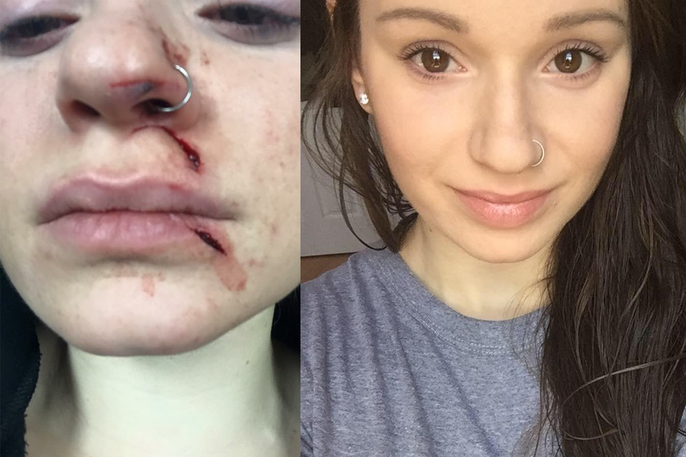NYC Slashing Victim Undergoes an Amazing Transformation 6 Months After Incident featured image