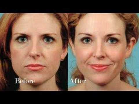 Dr. Mentz Facial Rejuvenation featured image