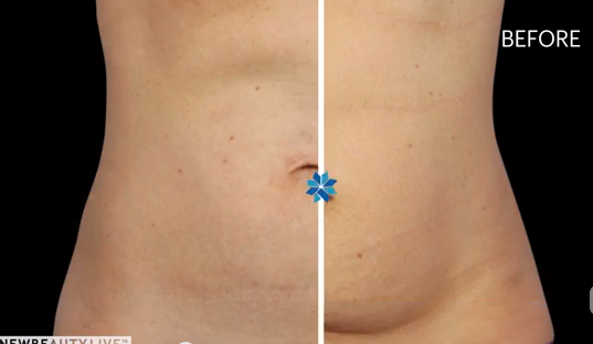 A Top Dermatologist Explains How CoolSculpting Really Works featured image