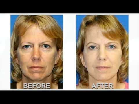 Dr. Karam Fat Transfer to Face, Facelift Surgery & Upper Eyelid Surgery Before and After featured image
