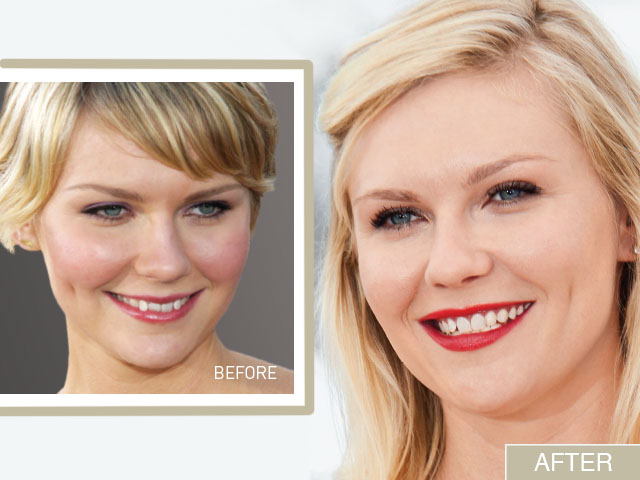 Kirsten Dunst’s Smile Makeover: From Crooked To Confident featured image