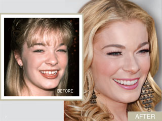 Leann Rimes Smile Makeover: From Gappy To Glam featured image