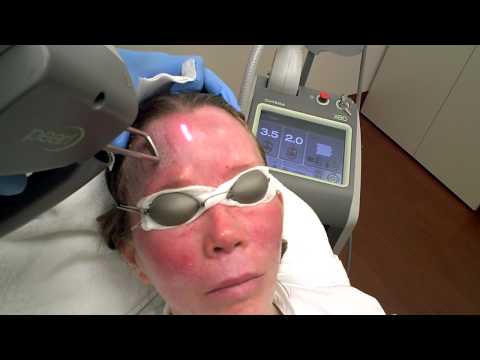 Dr. Jacono – Mini Face Lift With Pearl Laser featured image