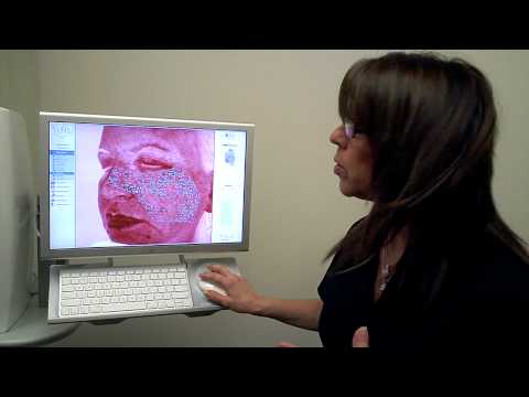 Dr. Jacono – Laser Skin Resurfacing featured image