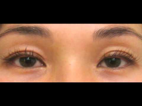 Dr. Fitzgerald – Watch Lashes Grow Before Your Eyes – Latisse At Dr. Rebecca Fitzgerald’s Office featured image