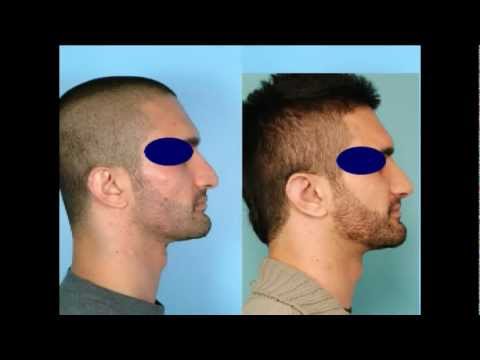 Dr. David Kim – Rhinoplasty – The Structural Approach To Rhinoplasty – Part 6 featured image