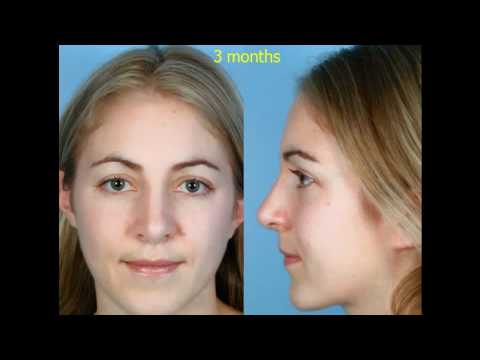 Dr. David Kim – Rhinoplasty – The Structural Approach To Rhinoplasty – Part 5 featured image