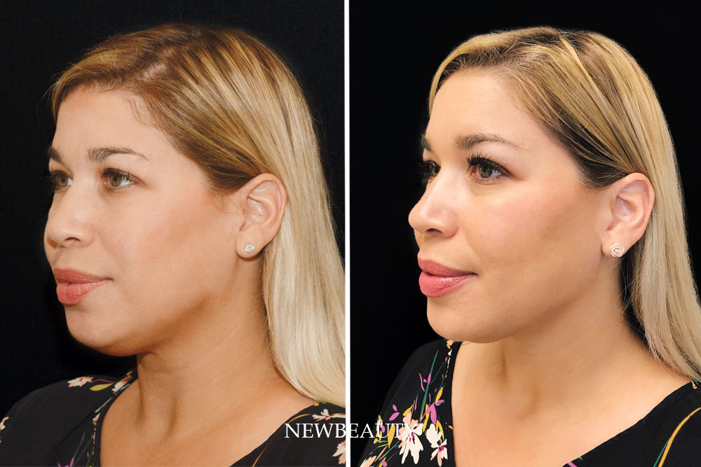 How CoolSculpting and Filler Gave My 40-Year-Old Face a Kardashian-Jenner Contour featured image