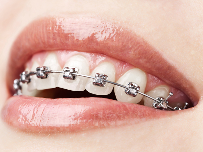 Poll: Would You Wear Braces as an Adult? featured image