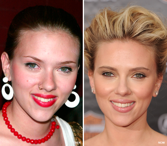 Scarlett Johansson Opens Up About How Adult Acne Affected Her Self-Image