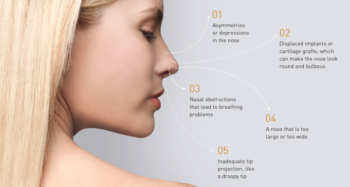 Top Five Reasons Patients Seek Rhinoplasty Revisions featured image