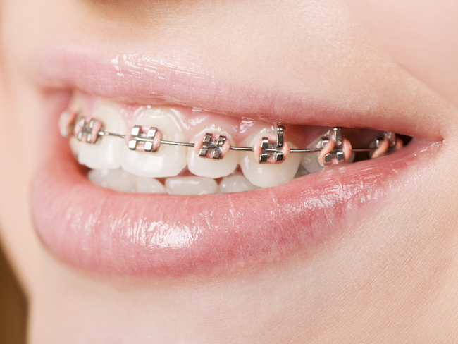 Braces: A Cure for Bad Breath? featured image