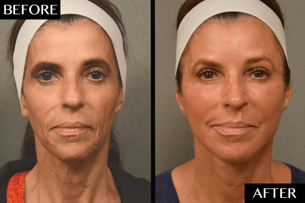 An Often-Overlooked Facial Rejuvenation Procedure Made This Woman Look 10–15 Years Younger featured image
