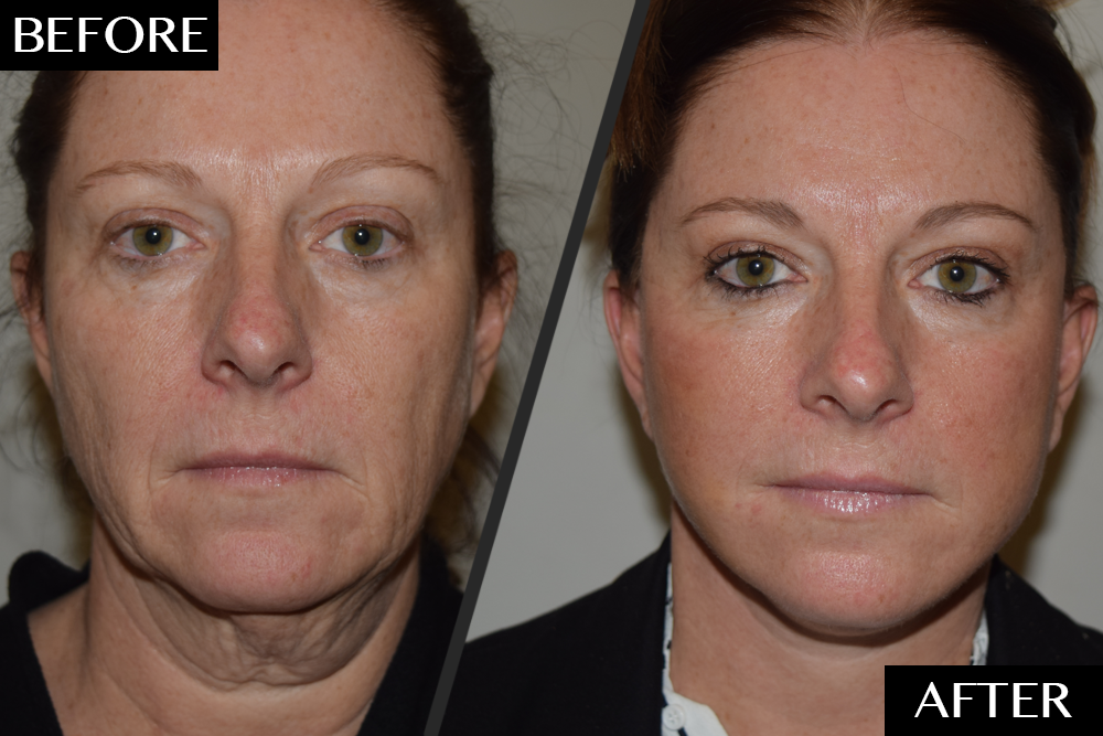 How a Split-Second Decision Restored This Woman’s Youthful Face featured image