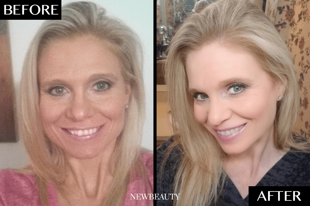 How This 47-Year-Old Woman Completely Transformed Her Smile From Home featured image