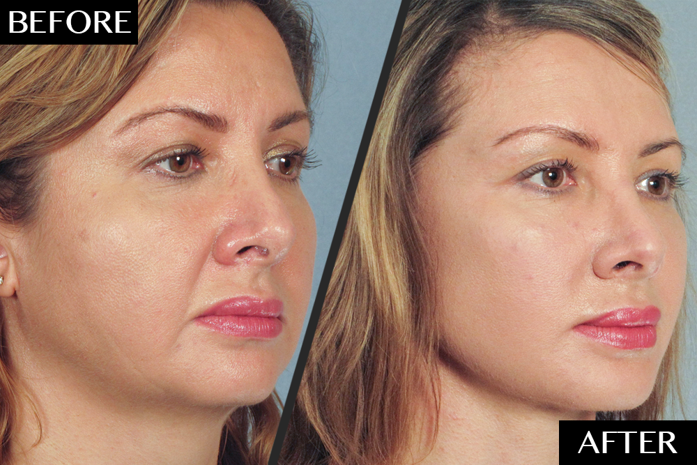 Why This Woman Got a Facelift—And Couldn’t Be Happier featured image
