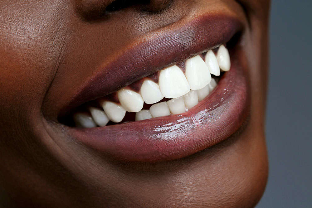 The Differences Between Veneers and Bonding You Probably Didn’t Know featured image