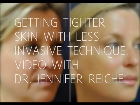 Dr. Reichel – Non-Invasive Skin Tightening and Lifting: Ultherapy featured image
