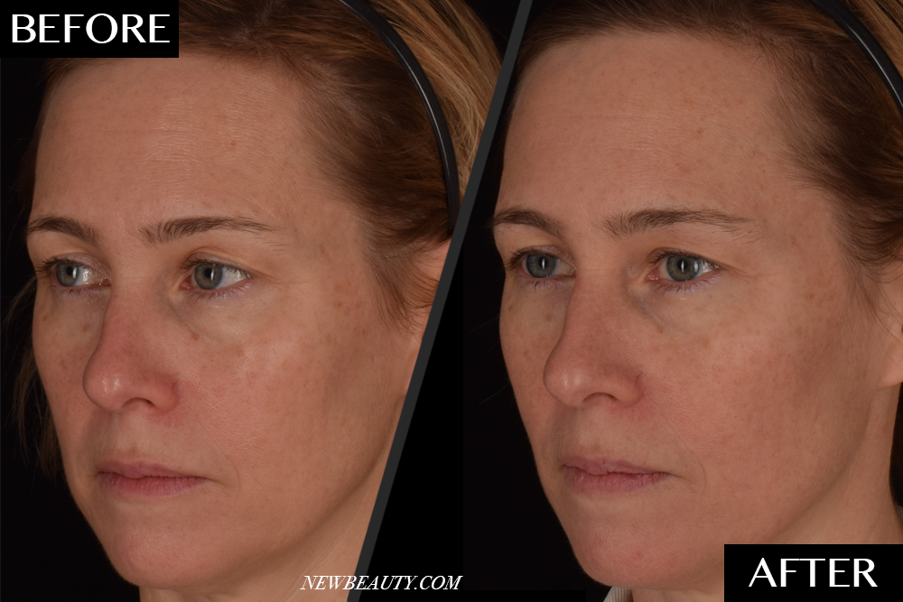 The New ‘Natural’ Filler That Uses Your Own Blood to Plump Up Your Skin featured image