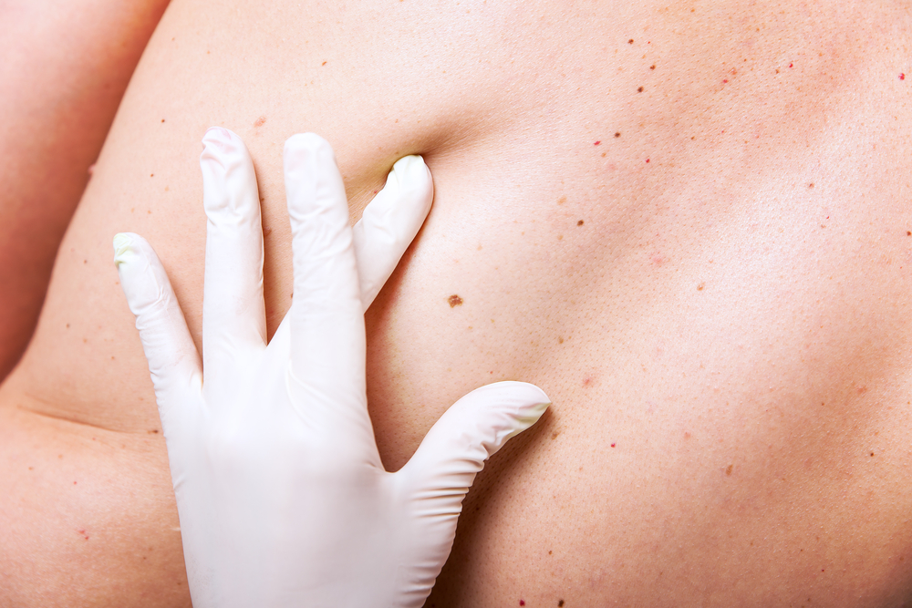 How This Keen-Eyed Sports Fan Saved a Life by  Spotting a Cancerous Mole featured image