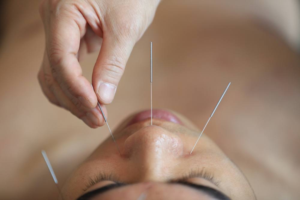 Bee-Based Acupuncture Causes One Woman to Die featured image