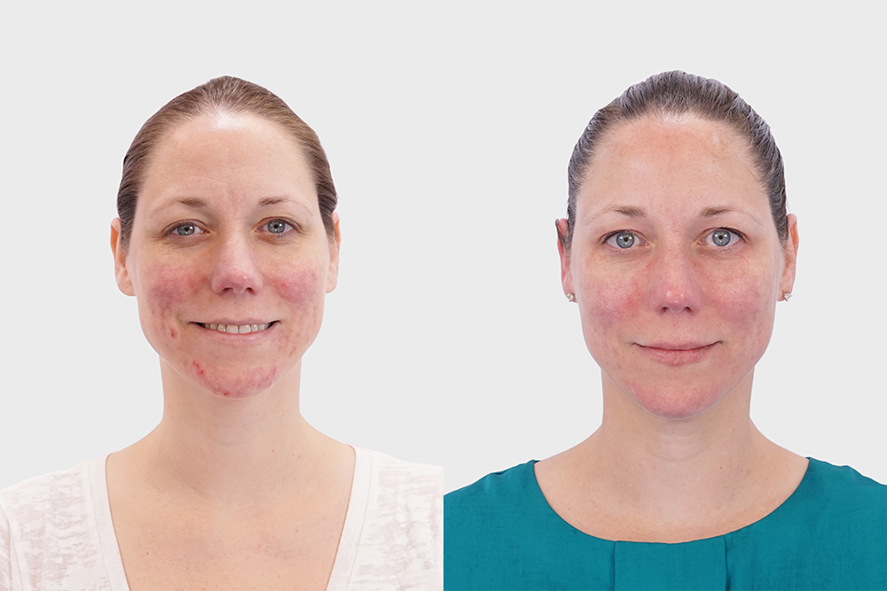 This New Acne-Fighting Treatment Is a Major Game Changer For Inflamed Skin featured image