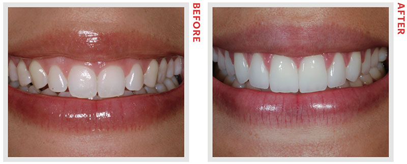 The Differences Between Veneers and Bonding You Probably ... from www.newbe...