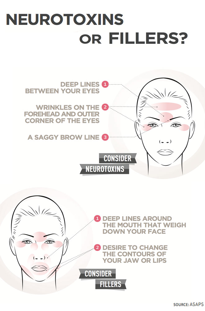 Infographic: Neurotoxins or Fillers? featured image