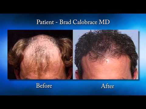NeoGraft Procedure Takes Hair Transplantation to New Heights featured image