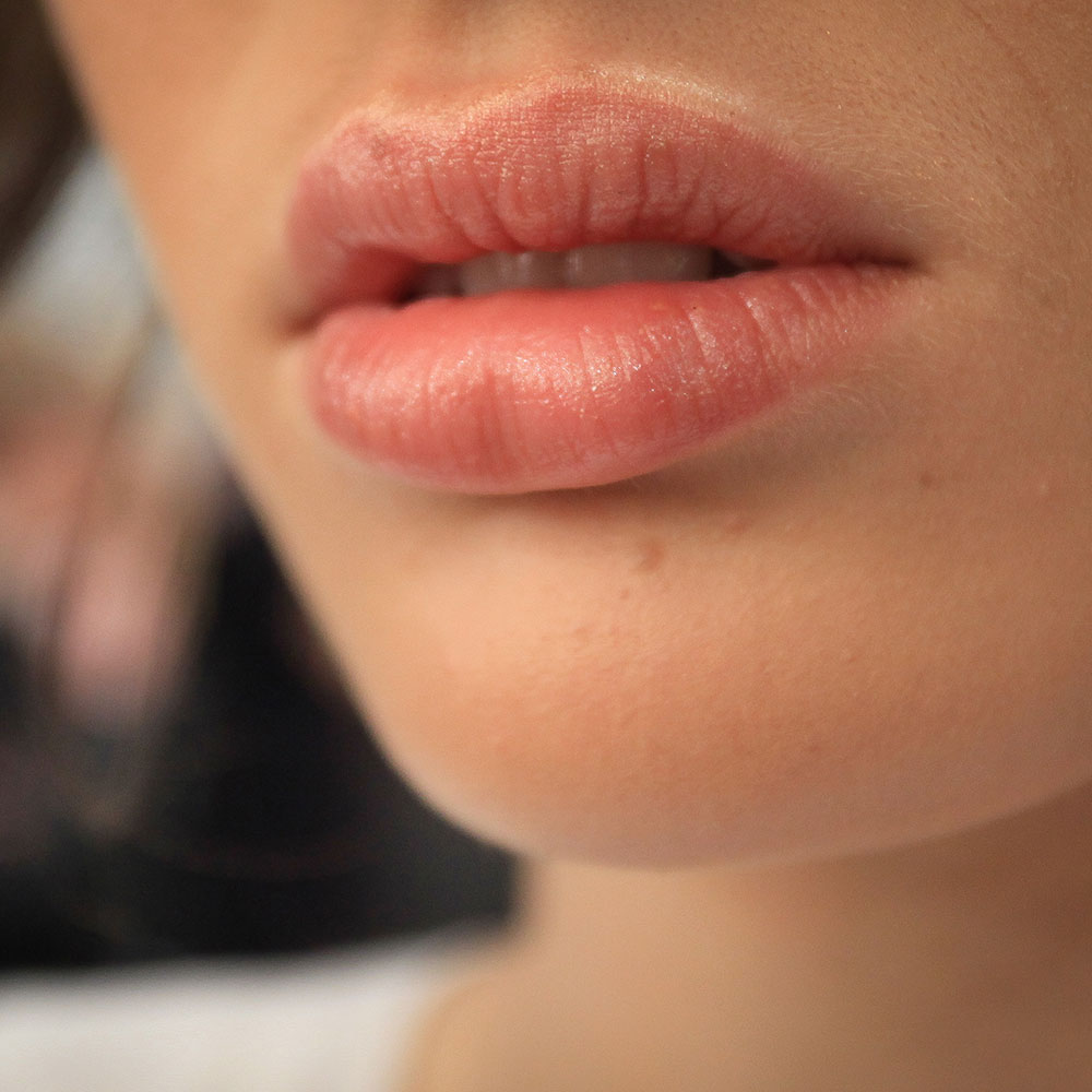 lipfillers