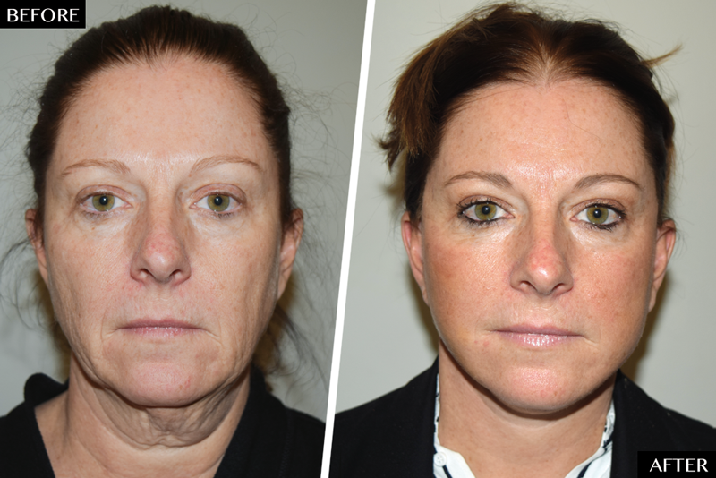 Why More 40-Somethings Than Ever Want Facelifts - NewBeauty