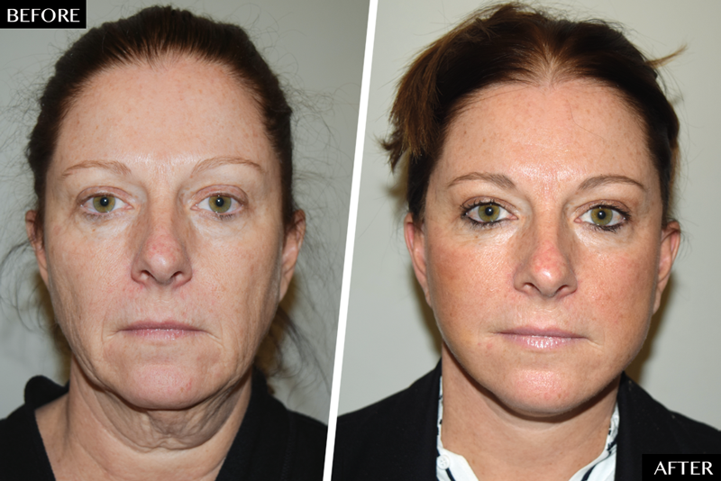 Why More 40 Somethings Than Ever Want Facelifts Newbeauty