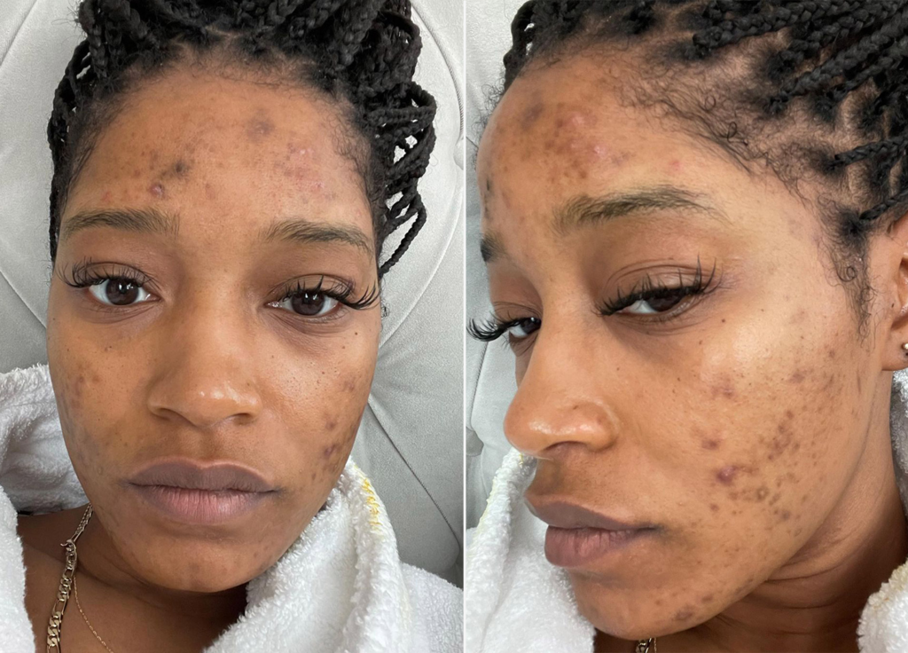 Keke Palmer Gets Real About Her Long-Time Struggle With Acne featured image