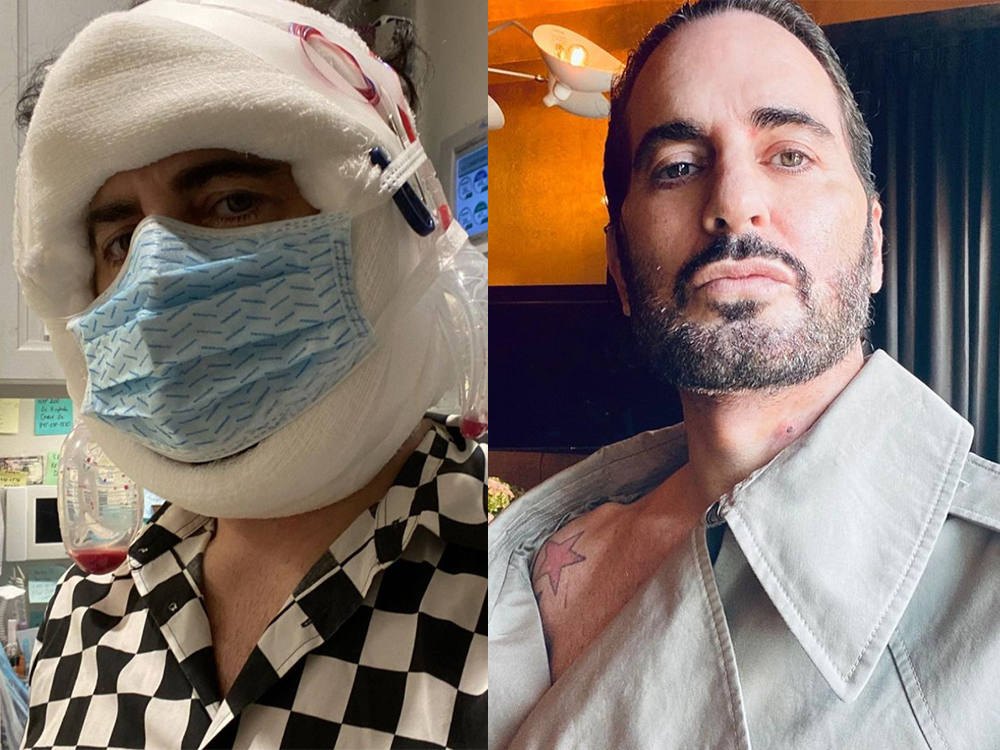 Marc Jacobs Shares Results of a Recent Facelift That Uses This Special Technique featured image