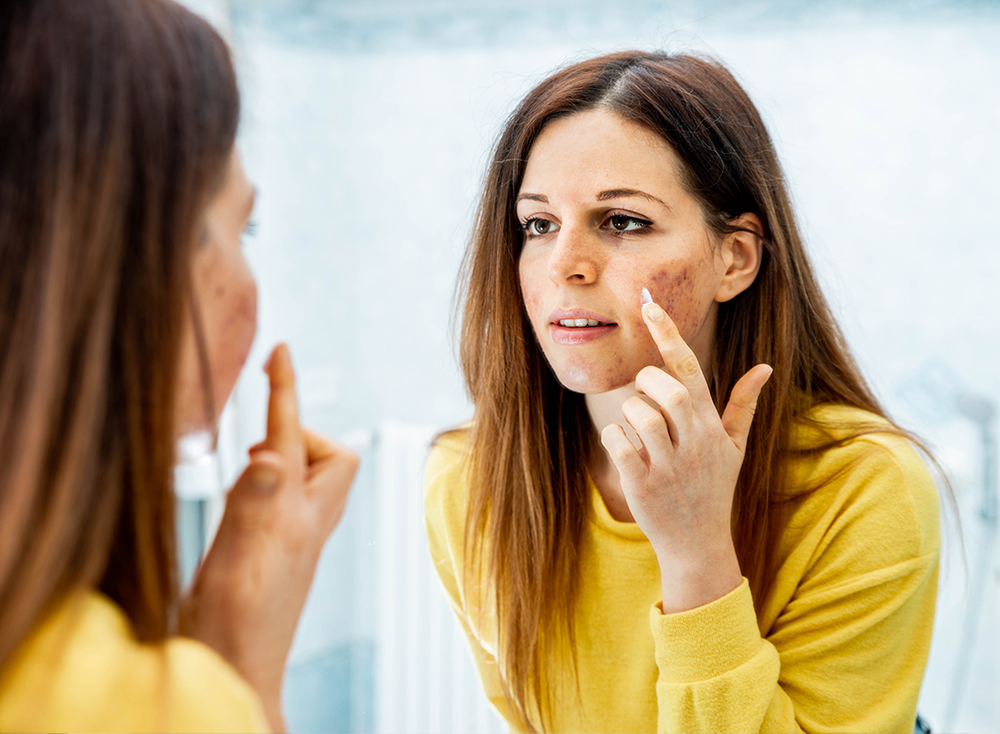 Skin-Care Experts Answer 9 Popular Questions About Acne featured image