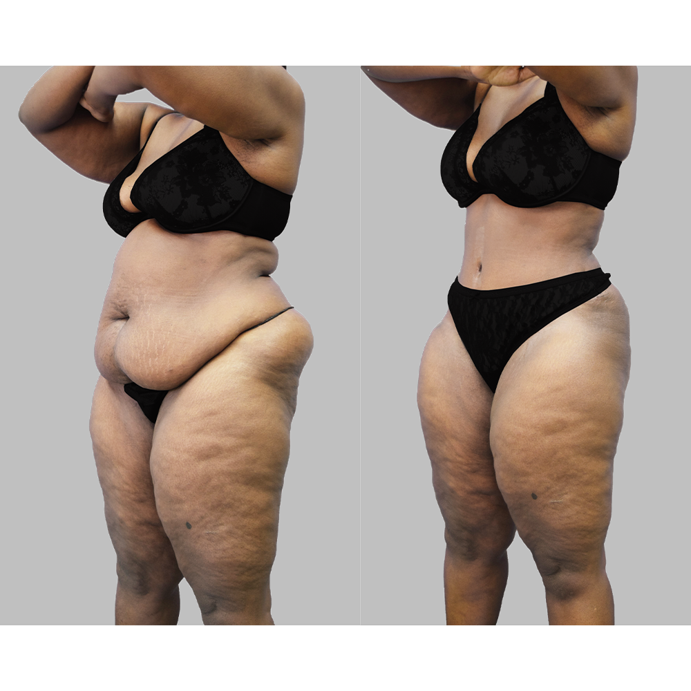 Tummy tuck with lipo on the flanks can create the hourglass shape -  Hourglass Tummy Tuck