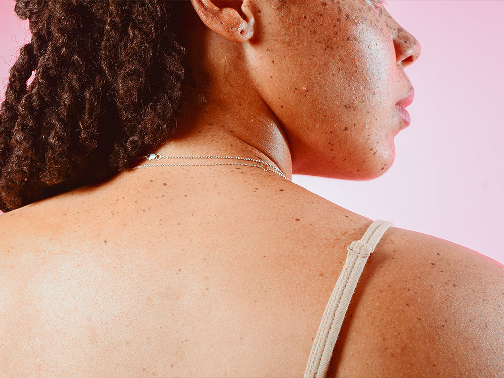 Experts Share the Best Ways to Treat ‘Bacne’ Scars featured image