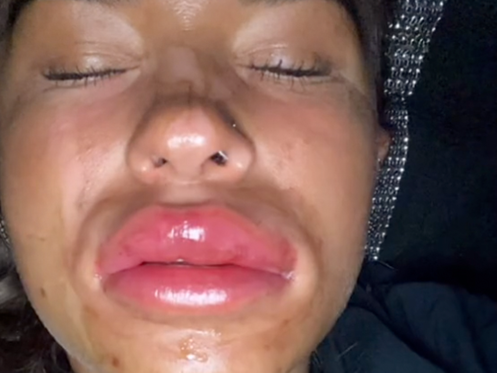This Viral Video Showcases the Danger of  Drinking After Getting Lip Filler featured image