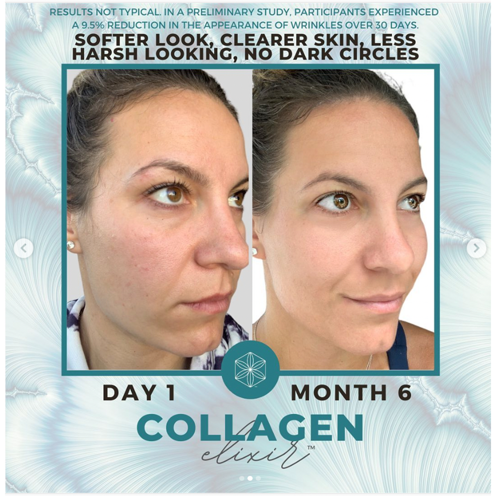 , Collagen Before and After: Results You Need to See
